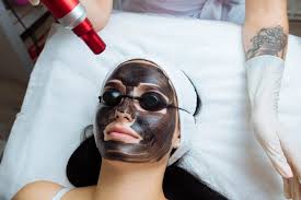 Carbon Laser Facial
