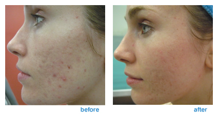 CO2 Laser Scar Treatment