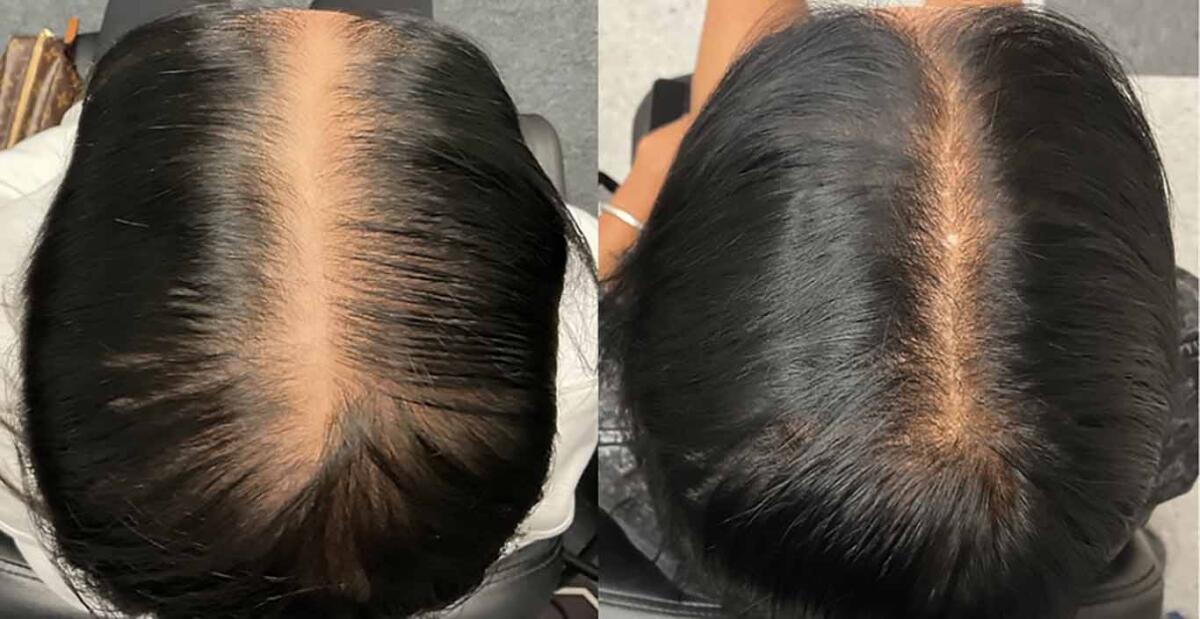 Hair Regrowth