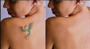 Tattoo Removal
